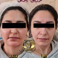 لیزر مو زائد/هایفو تراپی/ژل لب/تزریق چربی/بوتاکس|خدمات آرایشگری و زیبایی|اصفهان, جلفا|دیوار