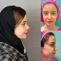 عمل جراحی بینی ،تخفیف ۵۰درصد هرساله بهمن