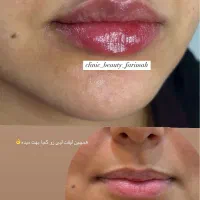 آف فیلر و بوتاکس فقطط۵۸۰|خدمات آرایشگری و زیبایی|ایذه, |دیوار