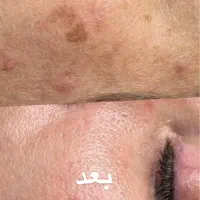 خال برداری و رفع کک ومک