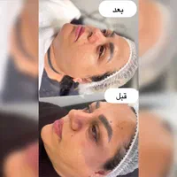 آموزش فیشال و پاکسازی تخصصی پوست مزونیدلینگ مزوایت|خدمات آرایشگری و زیبایی|مشهد, احمدآباد|دیوار