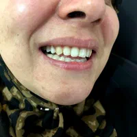 دندان مصنوعی + لابراتوار دندانسازی|خدمات آرایشگری و زیبایی|تهران, شهرک ولیعصر جنوبی|دیوار