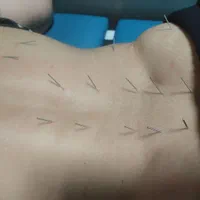 فیزیوتراپی و طب سوزنی و لیزردرمانی|خدمات آرایشگری و زیبایی|کرمانشاه, |دیوار