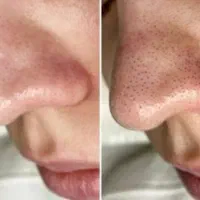 فیشیال و پاکسازی وجوانسازی پوست|خدمات آرایشگری و زیبایی|خوی, |دیوار