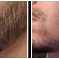 پرپشتی ریش