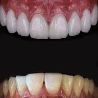 دندانپزشکی قسطی ایمپلنت عصبکشی روکش کامپوزیت