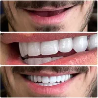 دندانسازی لبخند نو ، دندان مصنوعی طبیعی (اراک)