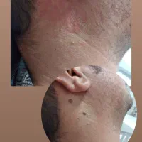 خدمات لیزر خال و منگوله های گوشتی،همورییدوزیگیل|خدمات زیبایی و سلامت|تهران, مسعودیه|دیوار