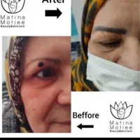 فیشال تخصصی، برداشت خال و ککو مک، ژل و بوتاکس|خدمات آرایشگری و زیبایی|شاهرود, |دیوار