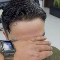 پروتز مو
