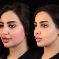 ٪50 آفر مزو prp بوتاکس فیلر لب زاویه سازی فیلرچانه|خدمات آرایشگری و زیبایی|مشهد, وکیل‌آباد|دیوار