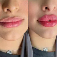 پزشک متخصص ژل و بوتاکس لیفت بانخ افزایش سایزآلت