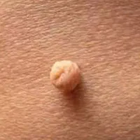 خدمات پلکسر از بین بردن خال وزیگیل|خدمات آرایشگری و زیبایی|پاکدشت, پاکدشت (مامازند)|دیوار