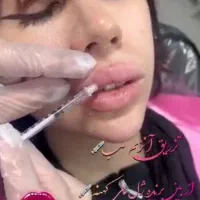 آموزش تخصصی ژل و بوتاکس