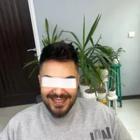 پروتز مو. نصب پروتز تعویض چسب کوتاهی مو