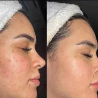 راهنمایی از، بین بردن جای جوش و اسکار|فعالیت داوطلبانه تحقیقاتی|کرمانشاه, |دیوار