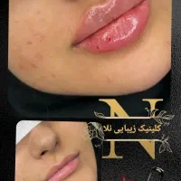 ژل بوتاکس خالبرداری|خدمات آرایشگری و زیبایی|زابل, |دیوار