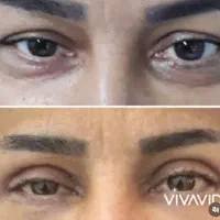 جراحی بلفاروپلاستی|خدمات آرایشگری و زیبایی|تهران, ده‌ونک|دیوار