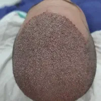کاشت مو و ابرو و ریش