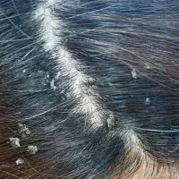 درمان انواع مشکلات پوست و مو|آرایشی، بهداشتی، درمانی|بروجرد, |دیوار