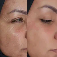 آف ژل و بوتاکس .مزو وآنزیم...|خدمات آرایشگری و زیبایی|ایذه, |دیوار