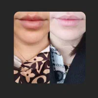 مدل فیلر لب