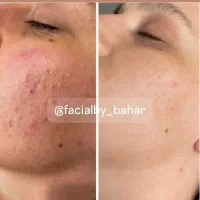 مزونیدلینگ حرفه‌ای در کلینیک زیبایی/هاشمیه