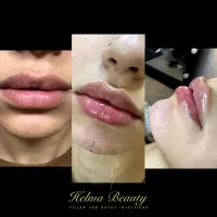 تزریق ژل و بوتاکس و انزیم و مزوجوانساز.|خدمات آرایشگری و زیبایی|پاکدشت, شهرک امام رضا|دیوار