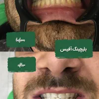 تخفیف استثنایی بلیچینگ دندان، جشنواره بهاره