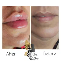 زیبایی ماندگار با خدمات تخصصی ژل و بوتاکس|خدمات آرایشگری و زیبایی|صدرا-فارس, فاز ۱|دیوار