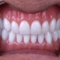 دندان مصنوعی / ژله ای / اوردنچر /چک صیادی / بیمه|خدمات آرایشگری و زیبایی|کرج, عظیمیه|دیوار