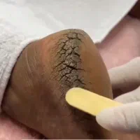 از شر ترک پاهات خلاص شو