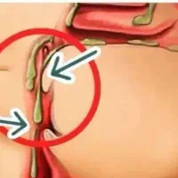 خلط پشت حلق داری