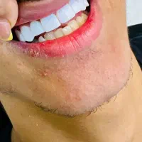 مدل کامپوزیت زیر نظر پزشک در کلینک دنداپزشکی|خدمات آرایشگری و زیبایی|اهواز, کیانپارس |دیوار