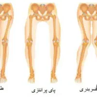مرکز تخصصی اصلاح غیرجراحی انحرافات زانو