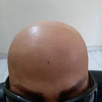 پروتز مو و ترمیم موی شقایق. چسب پروتز|خدمات آرایشگری و زیبایی|تبریز, |دیوار