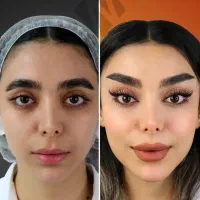 پروتز سینه لیفت سینه و پیکر تراشی