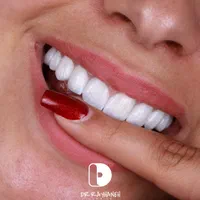 کامپوزیت دندان/لمینیت/دندانپزشکی|خدمات آرایشگری و زیبایی|مشهد, کوثر|دیوار