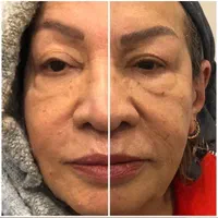 جشنواره لیزر موهای زائد|خدمات آرایشگری و زیبایی|قزوین, |دیوار