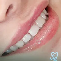 سفید کردن دندان (بلیچینگ)|خدمات آرایشگری و زیبایی|فولادشهر, B2|دیوار