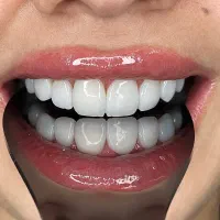 تخفیف ویژه زیبایی کامپوزیت ونییر و‌لمینت ‌