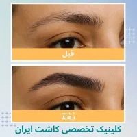 کاشت مو/ فول تراکم/ متد FIT/ بدون نیاز به جراحی|خدمات آرایشگری و زیبایی|تهران, دروس|دیوار
