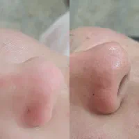 پاکسازی تخصصی صورت.خیابان دشتیار.بانبرز|خدمات آرایشگری و زیبایی|ایلام, |دیوار