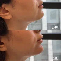 جشنواره *هفت روزه*تزریق ژل و بوتاکس،فیلر،مزوتراپی