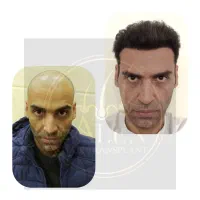 کاشت موی سر وابرو ..مزوتراپی