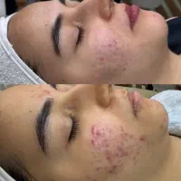 فشیال تخصصی پوست با بهترین مواد(10 درصد تخفیف)