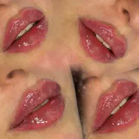 تزریق ژل و خدمات زیبایی همراه با بوتاکس رایگان