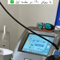 لیزرموهای زائد(قطعی)