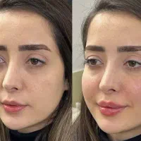 جشنواره فیلر و بوتاکس