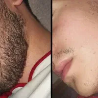 با ریزش موهات خداحافظی کن